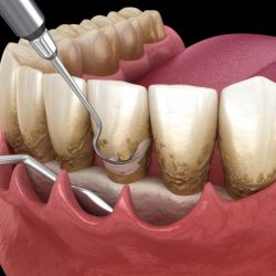 Periodontal mucosal grafting cpt code